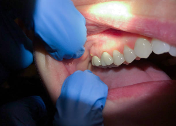 Best Emergency Treatment for Dental Infections or Abscesses in Palmetto, GA