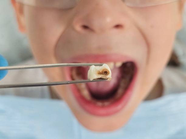 Best Emergency Root Canal Treatment in Palmetto, GA